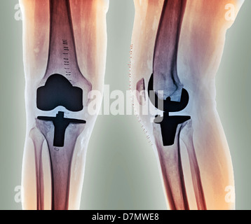 Un remplacement total du genou, des rayons x Banque D'Images