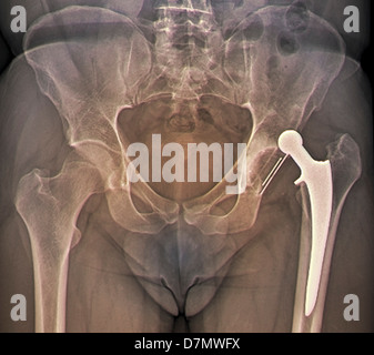 Remplacement de la hanche disloquée, X-ray Banque D'Images