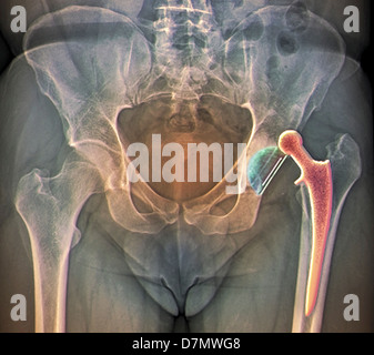 Remplacement de la hanche disloquée, X-ray Banque D'Images