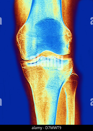 Articulation du Genou, x-ray Banque D'Images