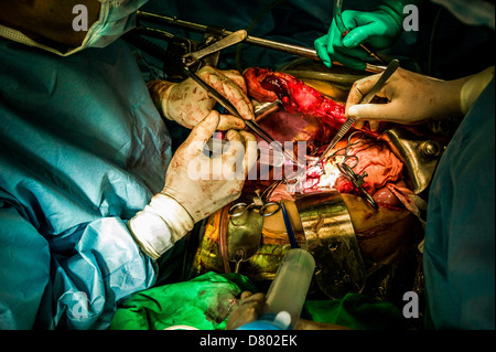 Chirurgiens d'effectuer une transplantation du foie. Banque D'Images