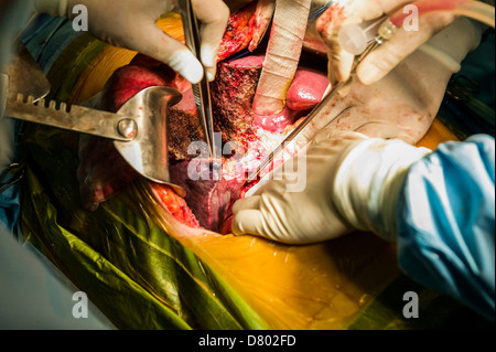 Chirurgiens d'effectuer une transplantation du foie. Banque D'Images