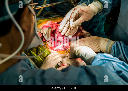 Chirurgiens d'effectuer une transplantation du foie. Banque D'Images