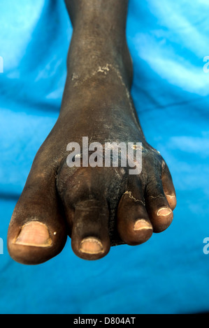 Actinomycetoma sur le pied gauche d'un homme de 47 ans. Banque D'Images