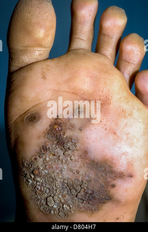 Eumycetoma dans le pied gauche d'un patient. Banque D'Images