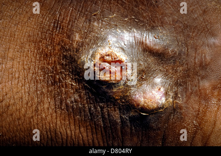 Close up of a guéri eumycetoma sur la cheville de l'homme de 20 ans. Banque D'Images