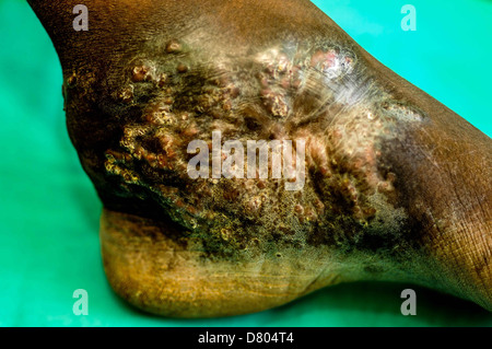 Actinomycetoma affectant la cheville d'un homme âgé du Soudan. Banque D'Images