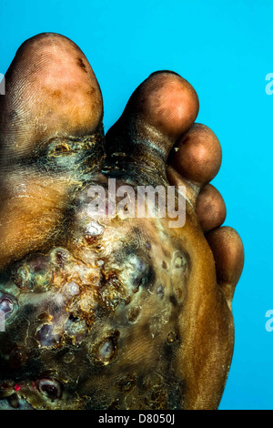 L'unique d'un pied d'un jeune homme souffrant de mycétome. Banque D'Images