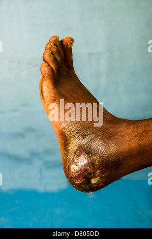 Close up of a pied avec eumycetoma. Banque D'Images