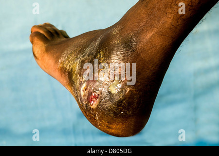 Close up of a pied avec eumycetoma. Banque D'Images