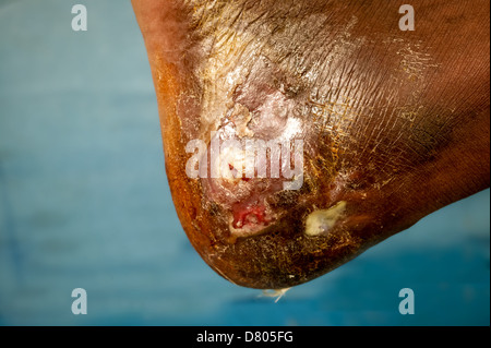 Close up of a pied avec eumycetoma. Banque D'Images