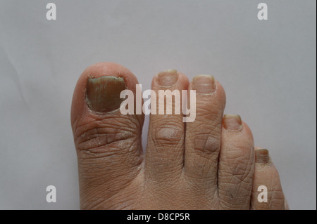 L'infection fongique des ongles, l'infection, l'homme pied pieds, incarné, Banque D'Images