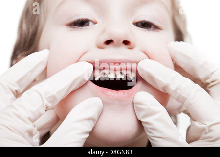 L'examen de la carie des dents carie Banque D'Images