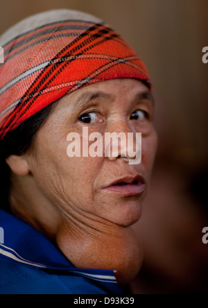 Minorité Akha Femme avec une grande tumeur, Ban Ta Mi, Laos Banque D'Images