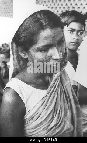 Indienne qui a survécu à la variole mais qui va porter les cicatrices pour le reste de sa vie, années 1970. Qui photographie de l Dale. Banque D'Images