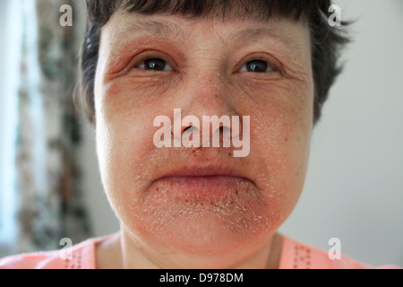 Femme souffrant d'un eczéma et une éruption couvrant la majeure partie de la face avec la douleur entourant & affectant les yeux & bouche Banque D'Images