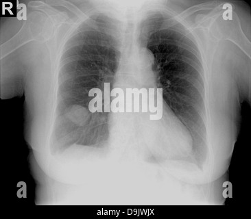 La radiographie du thorax par une tumeur sur le côté droit. Banque D'Images