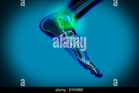 La vue X-ray de la douleur dans les pieds. Banque D'Images