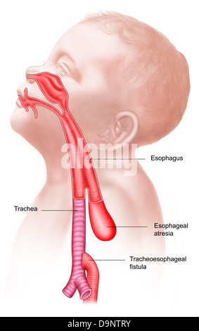 Anatomie d'une fistule trachéo-oesophagienne. Banque D'Images