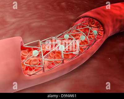 Vue microscopique d'une coupe transversale de l'artère avec l'écoulement de sang et le déploiement de l'endoprothèse. Banque D'Images