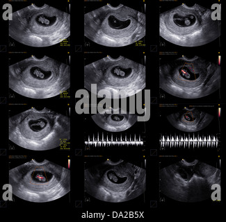 L'échographie endovaginale obstétrique embryon via approche Banque D'Images