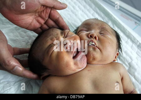 Bébé à deux têtes jumelles Conjoined sont nés dans la ville de Suining, le 5 mai 2011. Deux précédentes acquisitions ultrasonores en septembre et février deux revealled qu'un seul embryon, mais une numérisation finale deux jours avant l'accouchement revealled que la fille de mère Bao Qiaoying serait né avec deux têtes. Après la naissance, des tests de laboratoire ont montré que le bébé a deux épines et l'un et Banque D'Images