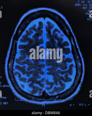 Cerveau humain / scan irm, X-ray Banque D'Images