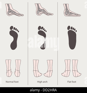 Jeu de pied plat, arc haut Banque D'Images