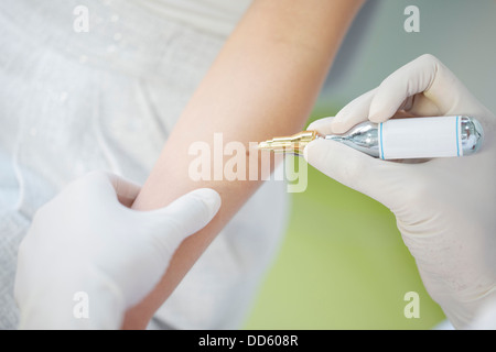 Dermatologie, traitement de la peau avec de l'azote liquide Banque D'Images