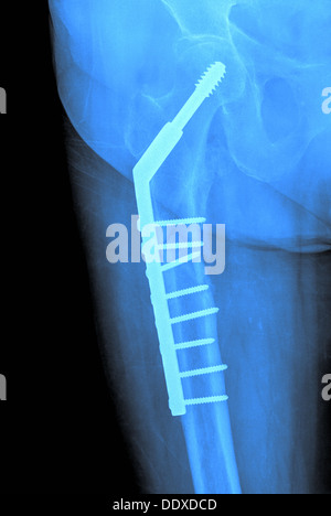 Des antécédents médicaux de l'image radiographique de la hanche Banque D'Images