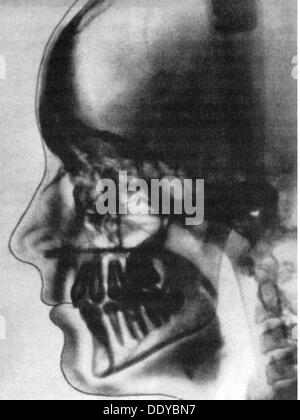 Médecine, irradiation / rayons X / mesure, tomographie d'une tête humaine, 1981, droits additionnels-Clearences-non disponible Banque D'Images