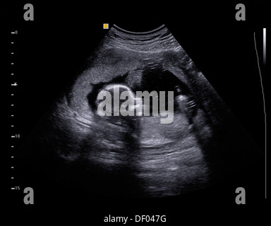 Échographie de bébé à 5 mois. Banque D'Images