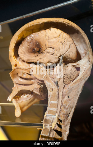 Spécimen de Plastination section sagittale de la tête et du cou Banque D'Images