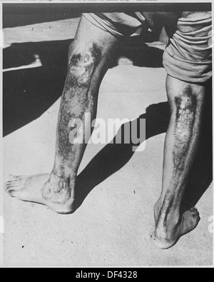 Une photographie représentant les effets graves de la chaleur atomique et des radiations sur les humains au Japon, montrant les conséquences dévastatrices de la bombe atomique pendant la seconde Guerre mondiale. Banque D'Images