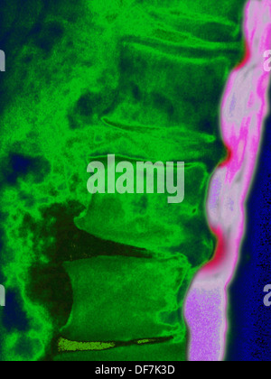 La hernie discale, X-RAY Banque D'Images