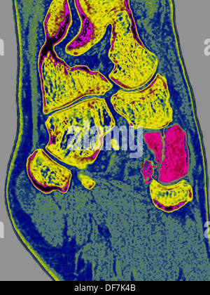 Fracture du pied, numérisation Banque D'Images