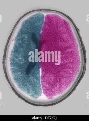 L'ŒDÈME CÉRÉBRAL CT SCAN Banque D'Images