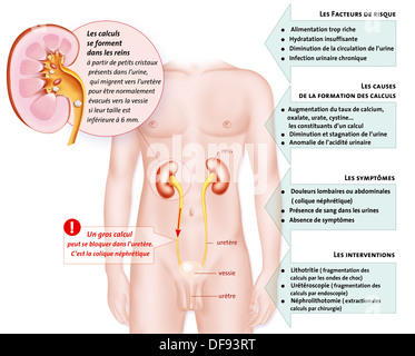 La lithiase rénale Dimensions Banque D'Images