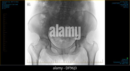 Ordinateur positif diagnostic medical X-Ray scan d'un montrant de la hanche chirurgie de remplacement des articulations qui ont besoin de soins de santé Banque D'Images