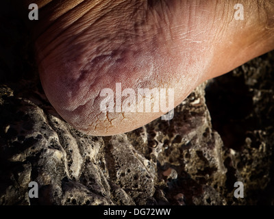 Vue rapprochée des fissures sur un talon. Banque D'Images