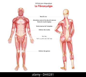 La fibromyalgie, dessin Banque D'Images