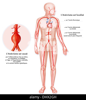 Anévrysme DE L'ARTÈRE, dessin Banque D'Images