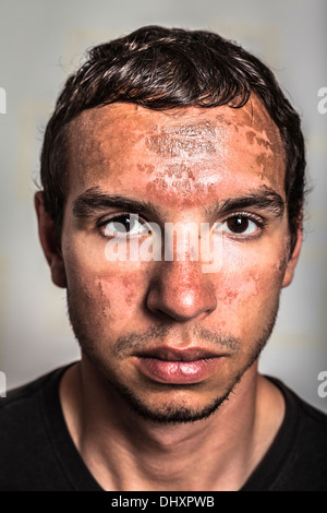 Peeling de la peau des coups de soleil sur le visage masculin causé par une exposition prolongée au soleil direct. Banque D'Images