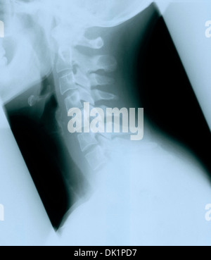 X-Ray de 30 year old woman's neck Banque D'Images