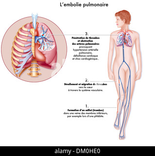 L'embolie pulmonaire, dessin Banque D'Images