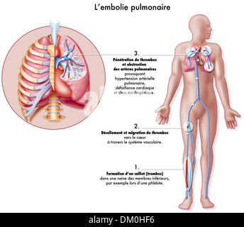 L'embolie pulmonaire, dessin Banque D'Images