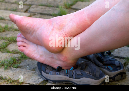 Gonflées, mal aux pieds d'un pélerin à Puente La Reina une ville basque le long du chemin de Saint-Jacques de Compostelle, Navarra, Espagne. Banque D'Images