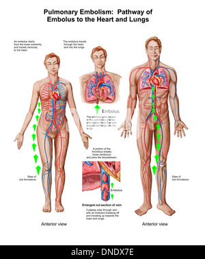 L'embolie pulmonaire, l'embolie de voie pour le cœur et les poumons. Banque D'Images