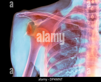 Luxation de l'épaule, X-ray Banque D'Images