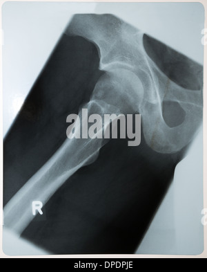 X-ray radiologie photographie des droits de l'hip Banque D'Images